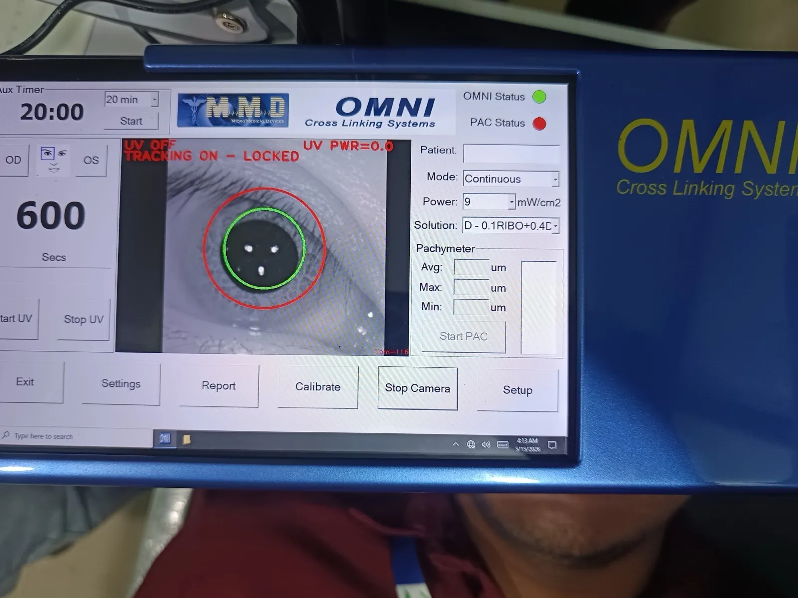 OMNI Cross Linking System tracking a patient's eye during a corneal cross-linking procedure at Ibotombi Eye Care